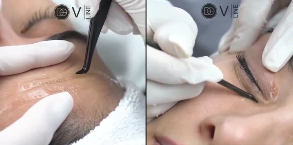 Skin Love Aesthetics is een huidverbeteringskliniek in Meppel. Verbeter je huid dankzij microneedling, fillers, injecties en permanente make-up, only the best for your skin!